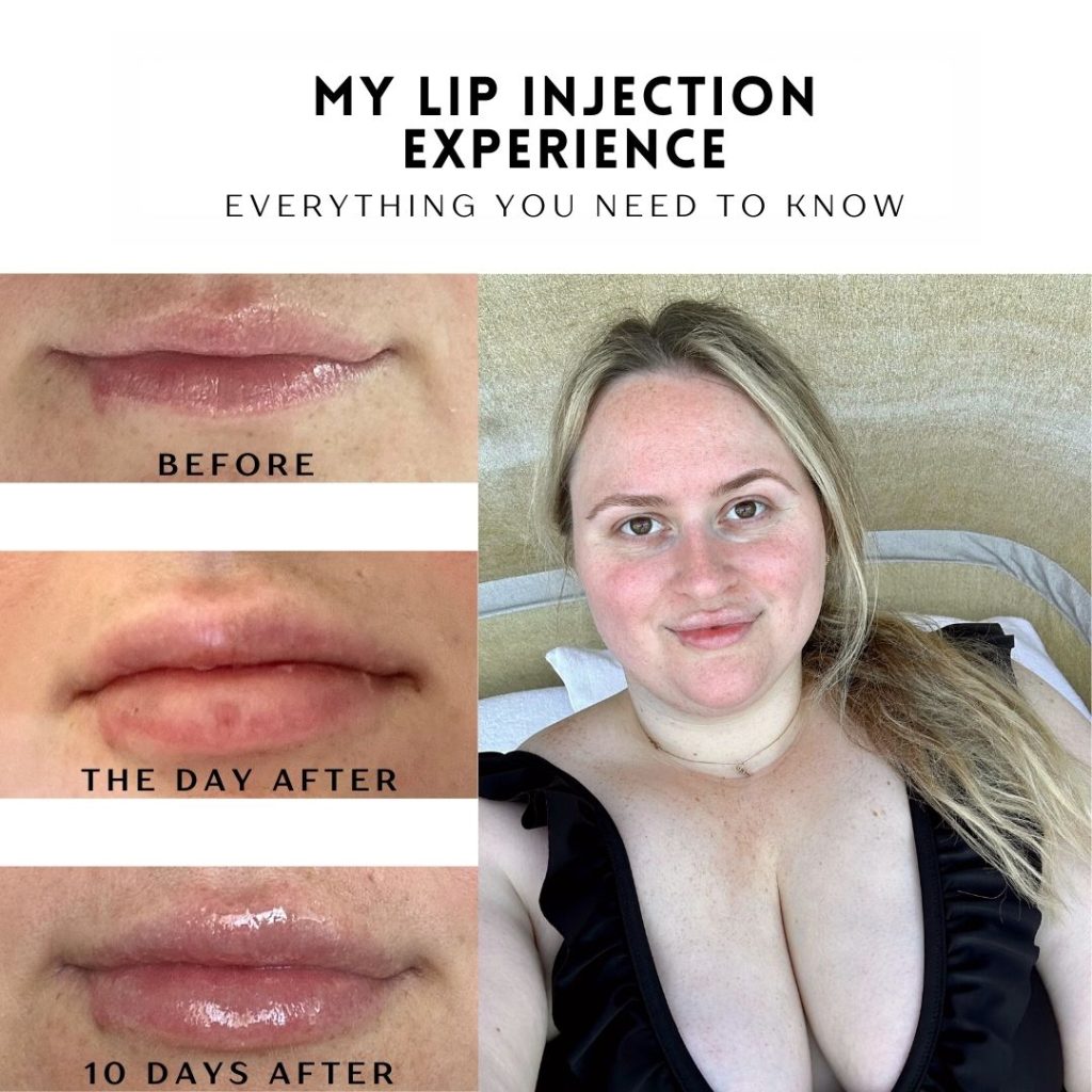 How to Get the Lips You Want: Natural Lip Enhancement